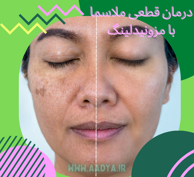 عکس صورت بعد از مزونیدلینگ نی نی سایت