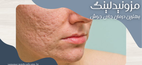 عکس صورت بعد از مزونیدلینگ نی نی سایت