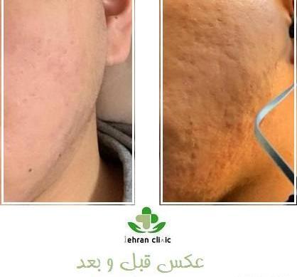 عکس صورت بعد از مزونیدلینگ نی نی سایت