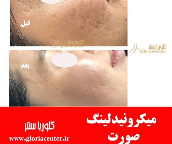 عکس صورت بعد از مزونیدلینگ نی نی سایت