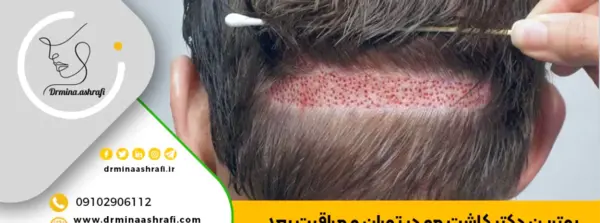عکس صورت بعد از مزونیدلینگ نی نی سایت