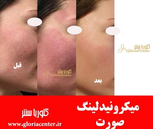 عکس صورت بعد از مزونیدلینگ نی نی سایت
