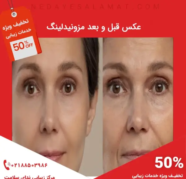 عکس صورت بعد از مزونیدلینگ نی نی سایت