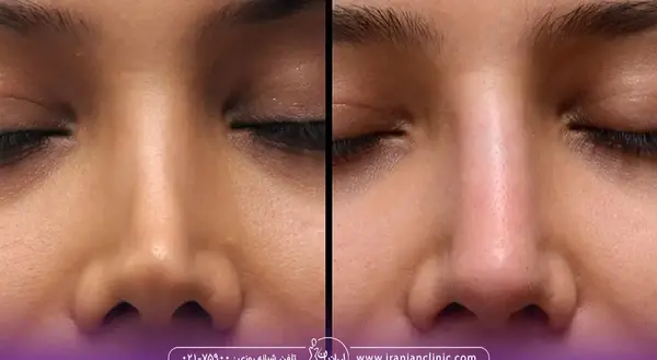 نامتقارن بودن صورت در عکس نی نی سایت