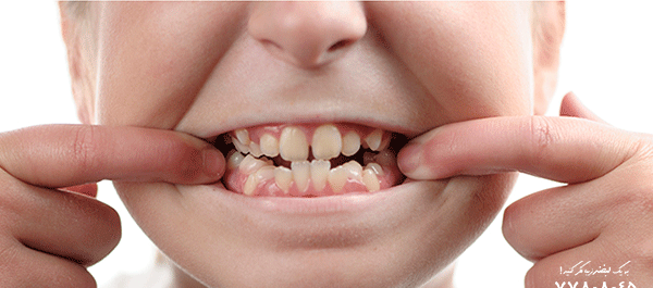 کج افتادن صورت در عکس نی نی سایت