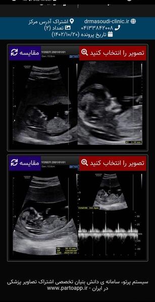 عکس سونوگرافی nt و تعیین جنسیت نی نی سایت