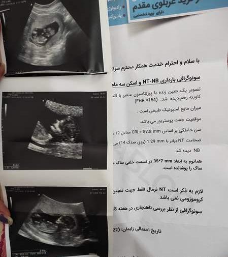 عکس سونوگرافی nt و تعیین جنسیت نی نی سایت