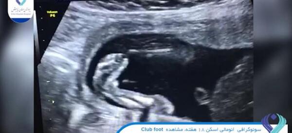 عکس جنین دختر در سونو آنومالی نی نی سایت