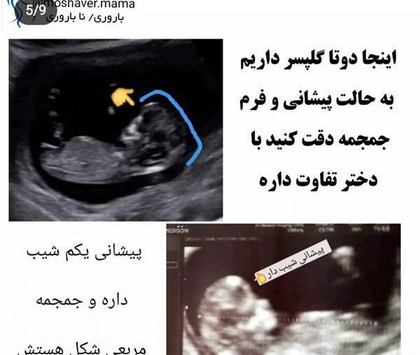 عکس جنین دختر در سونو آنومالی نی نی سایت