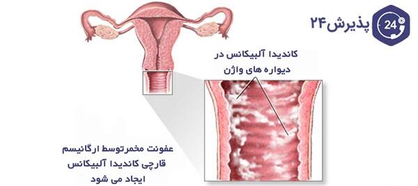 عکس قارچ ناحیه تناسلی زنان نی نی سایت