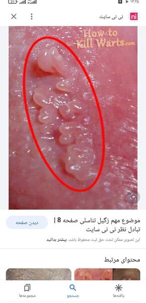 عکس زگیل تناسلی در زنان نی نی سایت