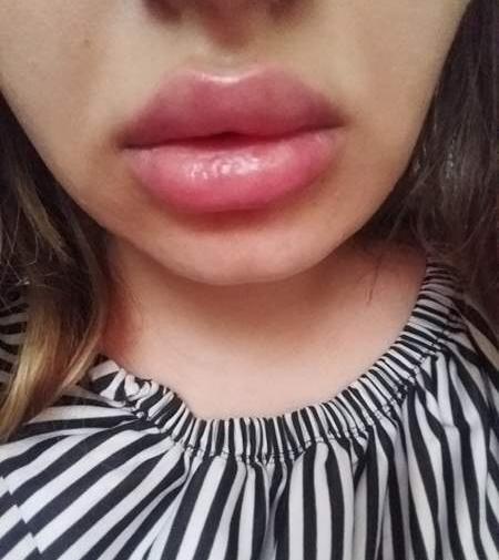 عکس تزریق یک سی سی ژل لب نی نی سایت