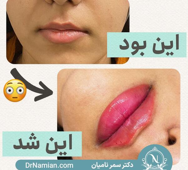 عکس تزریق یک سی سی ژل لب نی نی سایت