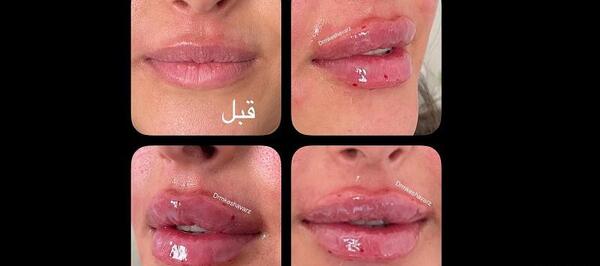 عکس تزریق یک سی سی ژل لب نی نی سایت