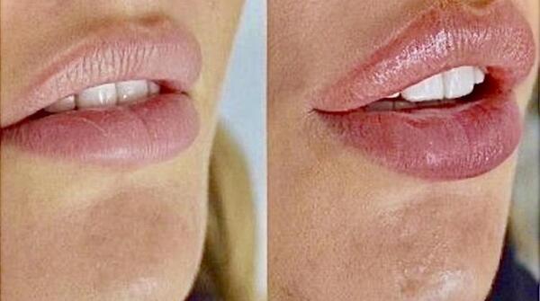 عکس تزریق یک سی سی ژل لب نی نی سایت