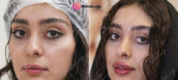 عکس تزریق یک سی سی ژل لب نی نی سایت
