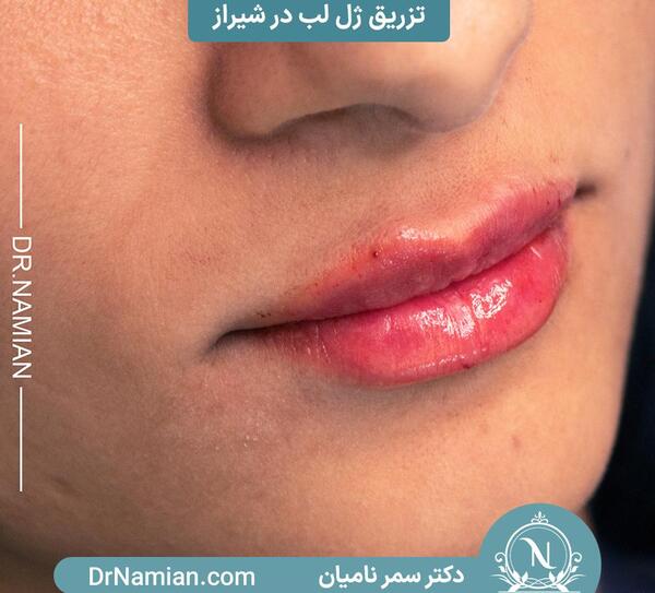 عکس تزریق یک سی سی ژل لب نی نی سایت