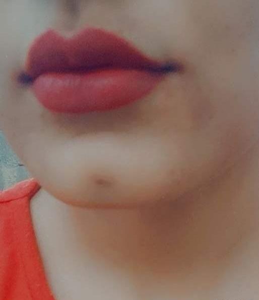 عکس تزریق یک سی سی ژل لب نی نی سایت
