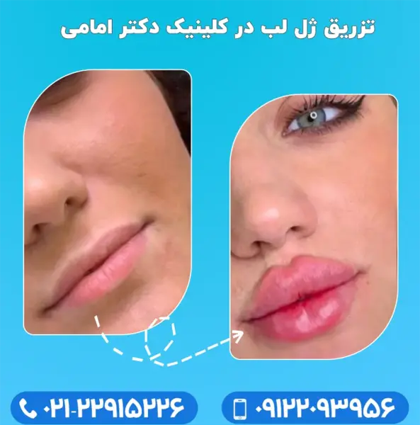 عکس تزریق ژل لب نیم سی سی نی نی سایت