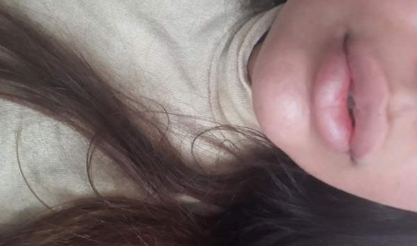 عکس تزریق ژل لب نیم سی سی نی نی سایت
