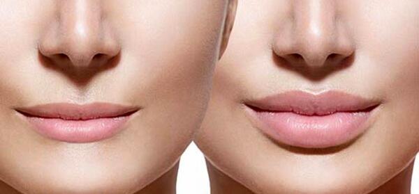 عکس تزریق ژل لب نیم سی سی نی نی سایت