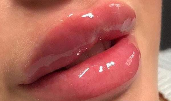 عکس تزریق ژل لب نیم سی سی نی نی سایت