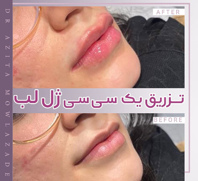 عکس تزریق ژل لب نیم سی سی نی نی سایت