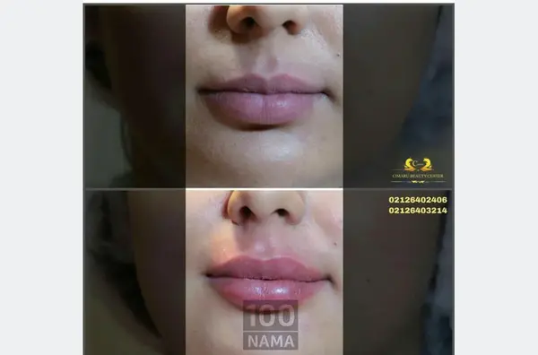 عکس تزریق ژل لب نیم سی سی نی نی سایت
