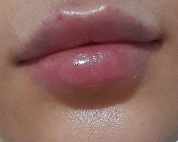 عکس تزریق ژل لب نیم سی سی نی نی سایت