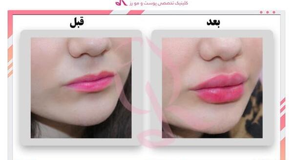 عکس تزریق ژل لب نیم سی سی نی نی سایت