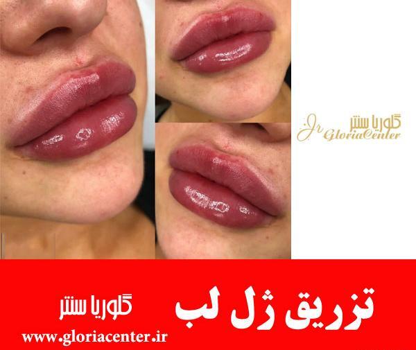 عکس تزریق ژل لب نیم سی سی نی نی سایت