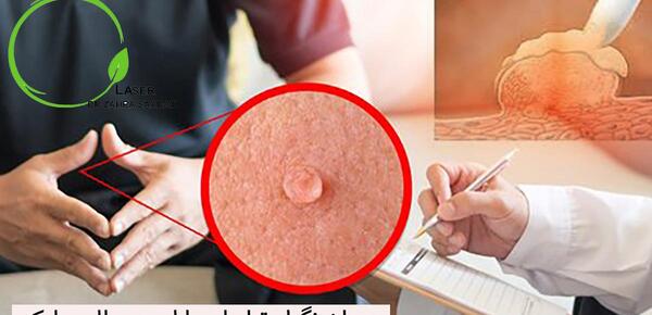 عکس زگيل روي سينه در بارداري نی نی سایت