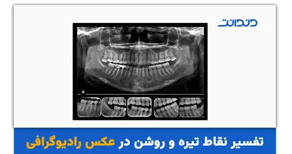 عکس رادیولوژی دندان در بارداری نی نی سایت