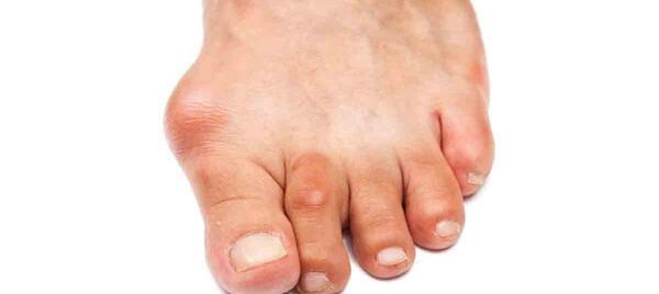 عکس میخچه پا نی نی سایت