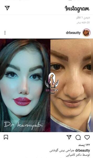 عکس عمل بینی گوشتی نی نی سایت