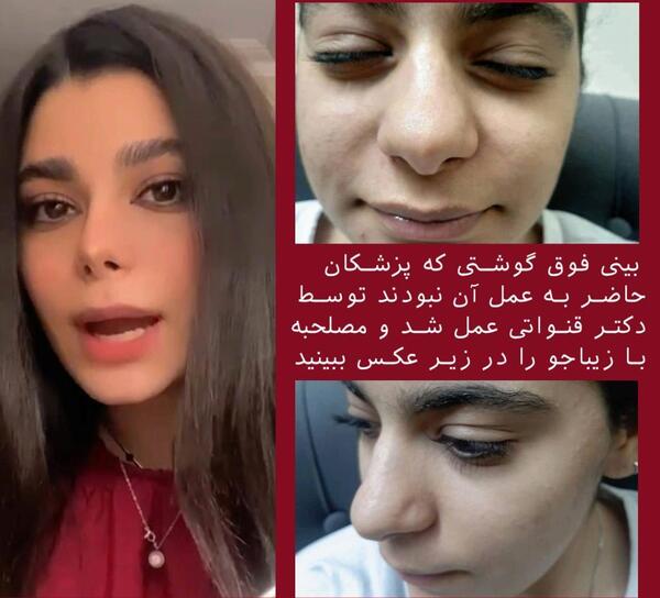 عکس عمل بینی گوشتی نی نی سایت