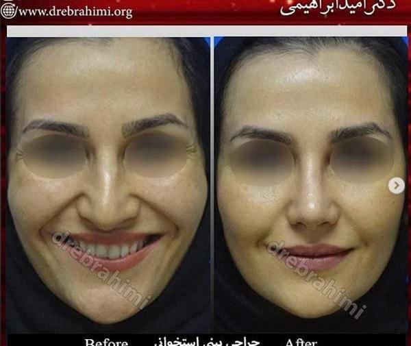 عکس عمل بینی گوشتی نی نی سایت