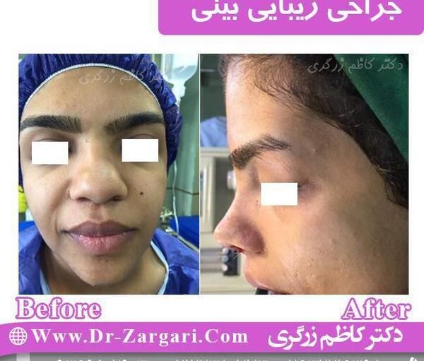 عکس عمل بینی گوشتی نی نی سایت