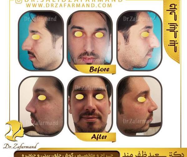 عکس عمل بینی گوشتی نی نی سایت