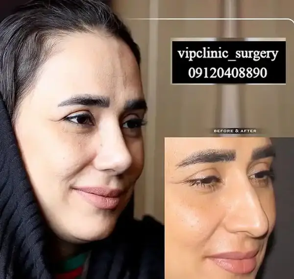 عکس عمل بینی گوشتی نی نی سایت