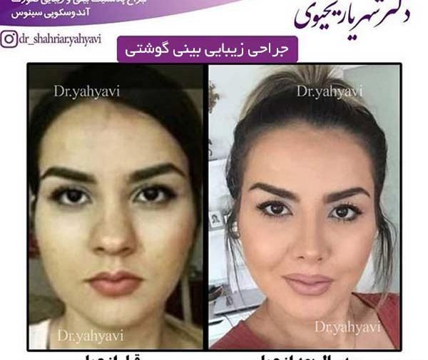 عکس عمل بینی گوشتی نی نی سایت