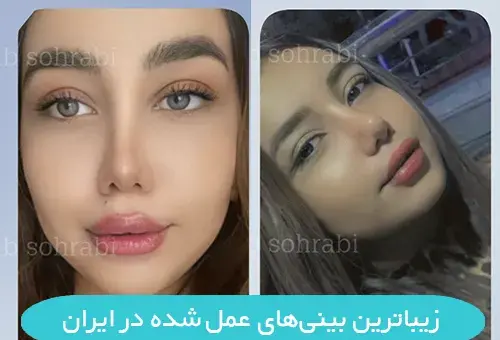 عکس بلافاصله بعد از عمل بینی نی نی سایت