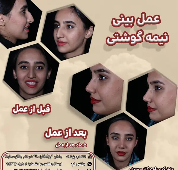عکس بلافاصله بعد از عمل بینی نی نی سایت
