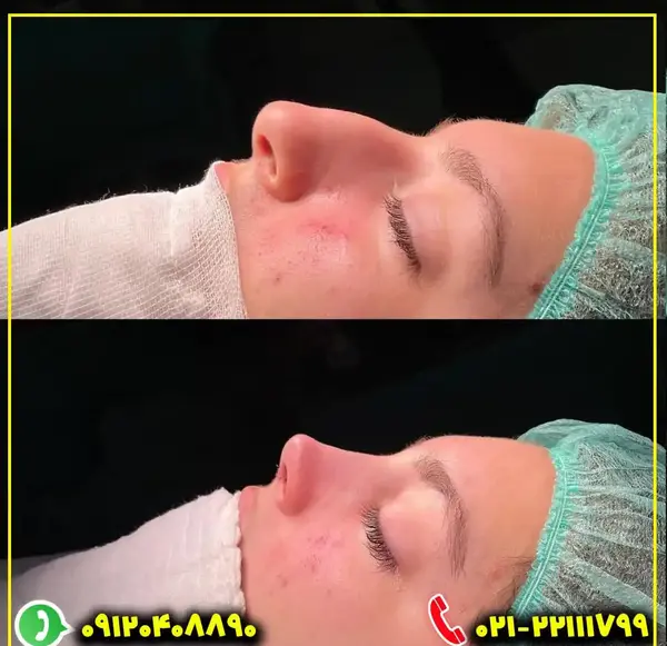 عکس بلافاصله بعد از عمل بینی نی نی سایت