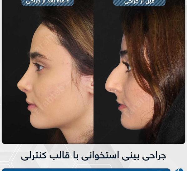 عکس بلافاصله بعد از عمل بینی نی نی سایت