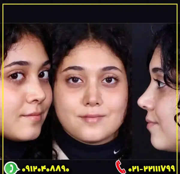 عکس بلافاصله بعد از عمل بینی نی نی سایت