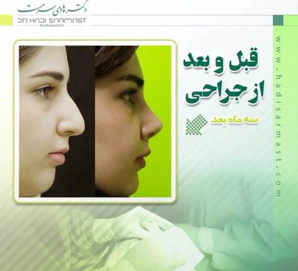 عکس بلافاصله بعد از عمل بینی نی نی سایت