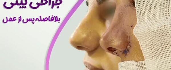 عکس بلافاصله بعد از عمل بینی نی نی سایت