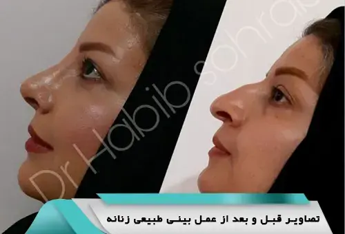 عکس بلافاصله بعد از عمل بینی نی نی سایت