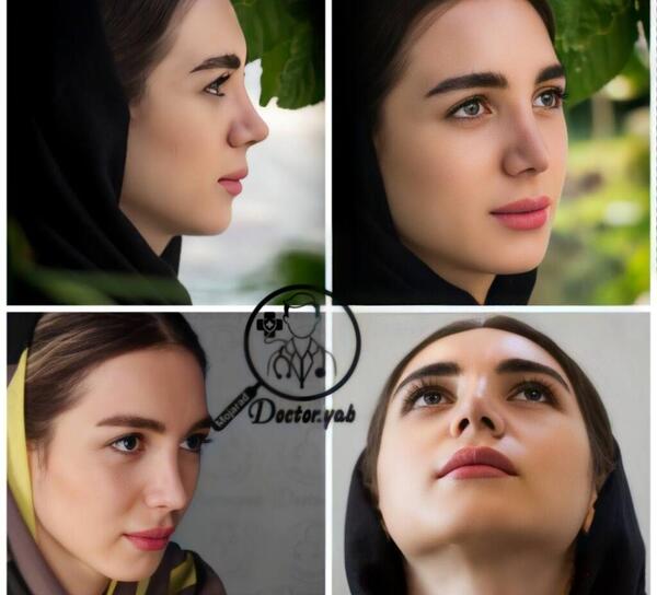 عکس بلافاصله بعد از عمل بینی نی نی سایت